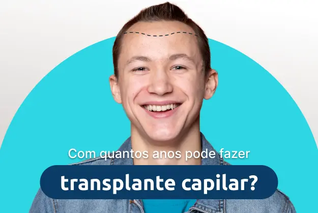 Quantos Anos Pode Fazer Transplante Capilar