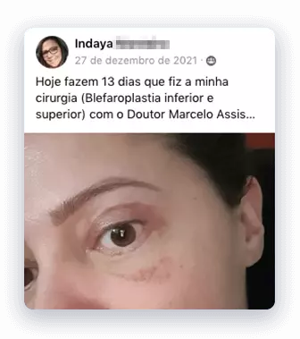 Cirurgia de Blefaroplastia inferior 4 blefaroplastia