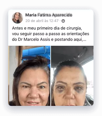 Cirurgia de Blefaroplastia inferior 7 blefaroplastia