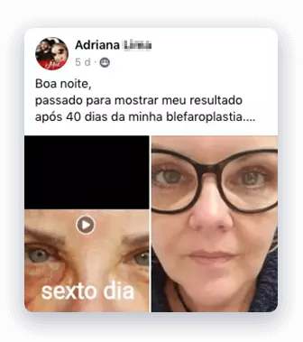 Cirurgia de Blefaroplastia inferior 8 blefaroplastia
