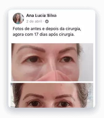 Cirurgia de Blefaroplastia inferior 5 blefaroplastia