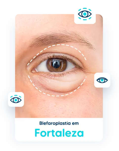 Blefaroplastia em Fortaleza 1 Blefaroplastia em Fortaleza
