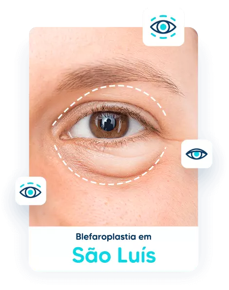 Blefaroplastia em São Luís 1 blefaroplastia em sao luis