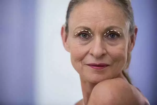 excesso de pele na pálpebra superior