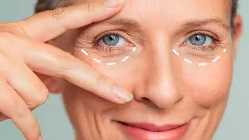 Bolsa de gordura na pálpebra inferior