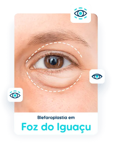 Blefaroplastia em Foz do Iguaçu