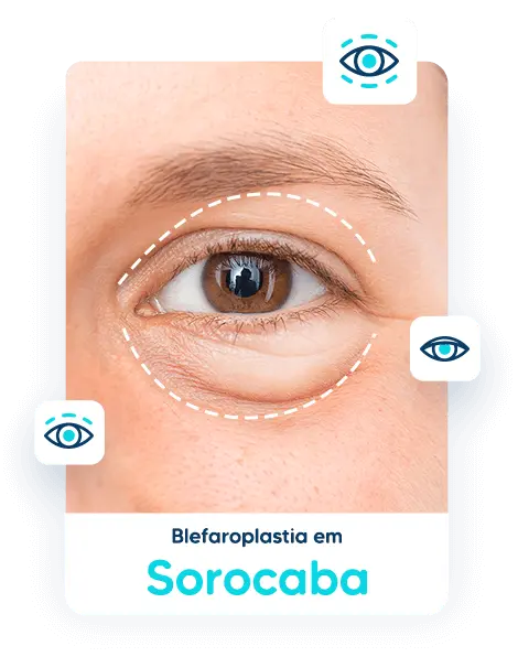 Blefaroplastia em Sorocaba 1 blefaroplastia em Sorocaba