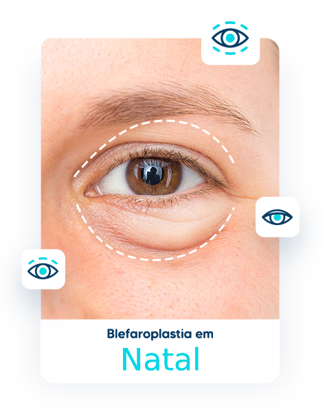 Blefaroplastia em Natal - RN 1 cidade 1