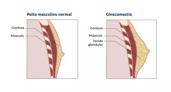 Ginecomastia: o que é, causas e cirurgia 1 o que é ginecomastia?