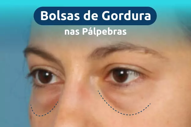  Bolsas De Gordura Nas P lpebras Preven o E Tratamento
