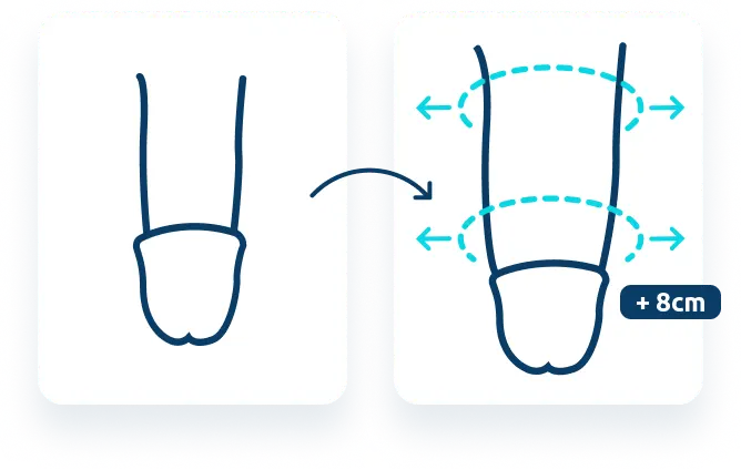 Harmonização peniana com urologista - Copy 2 Antes e depois da harmonização peniana