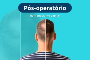 pós-operatório transplante capilar