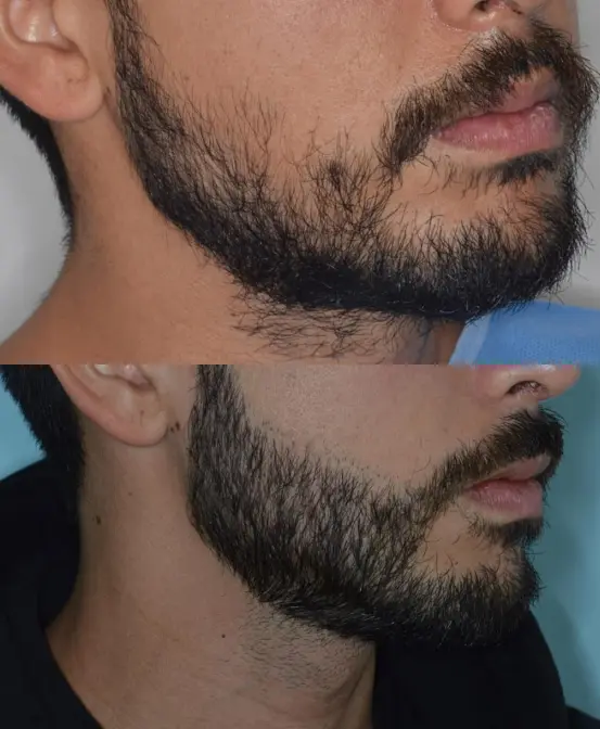 Transplante de barba 7 CEO do Projeto Orelhinha