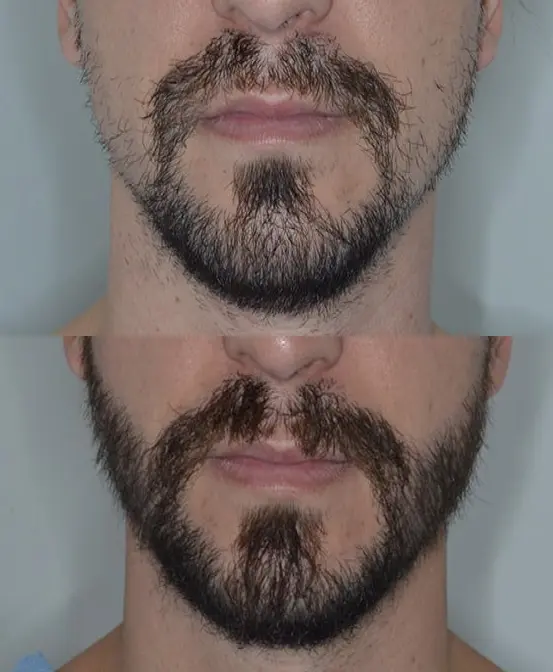 Transplante de barba 5 CEO do Projeto Orelhinha