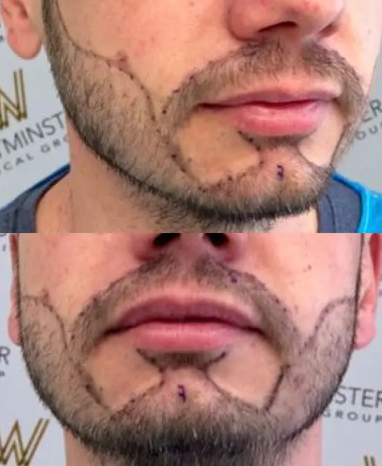 Transplante de barba 6 CEO do Projeto Orelhinha