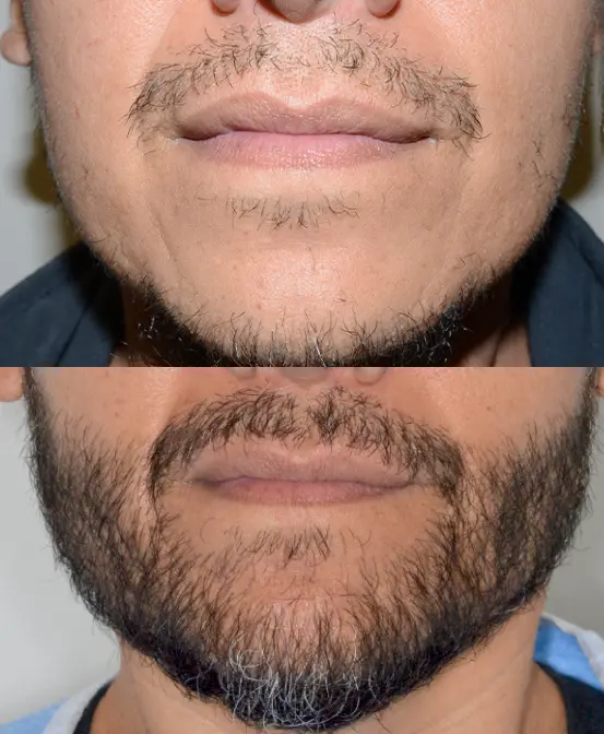 Transplante de barba 2 CEO do Projeto Orelhinha