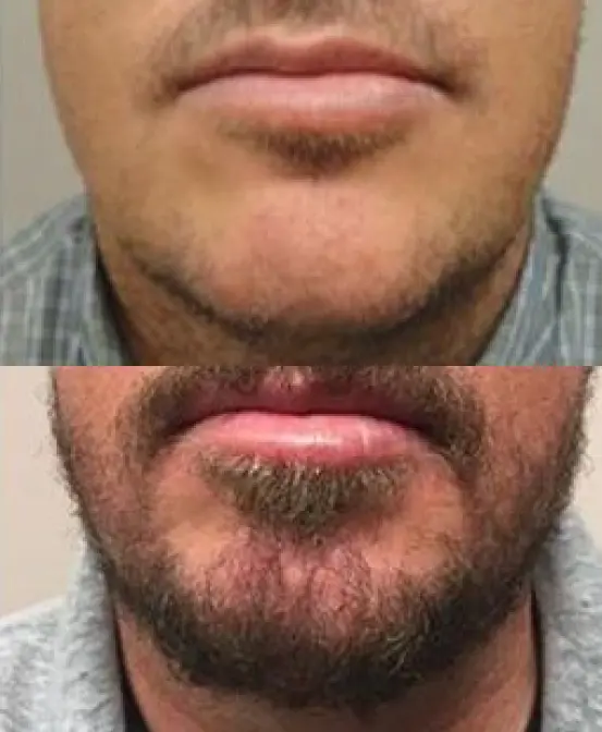 Transplante de barba 3 CEO do Projeto Orelhinha