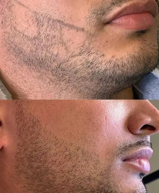 Transplante de barba 4 CEO do Projeto Orelhinha