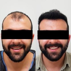 Transplante capilar com valores acessíveis 14 antes-e-depoiss-transplante-capilar-1