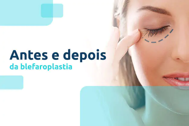 antes e depois blefaroplastia