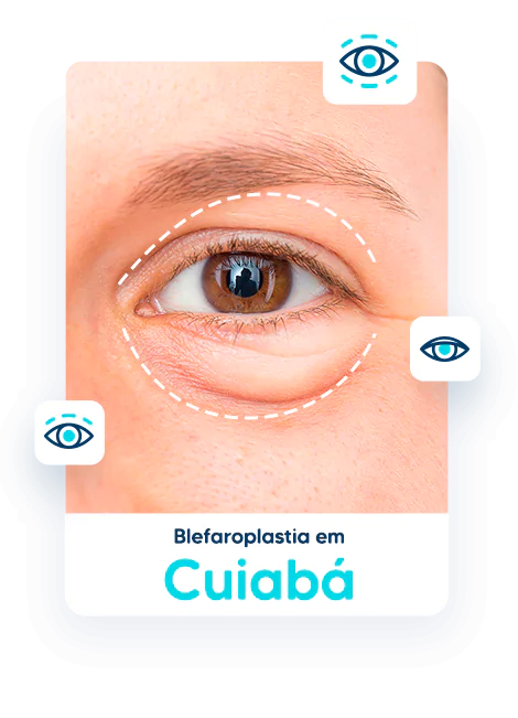 Blefaroplastia em Cuiabá 1 Blefaroplastia em Cuiabá