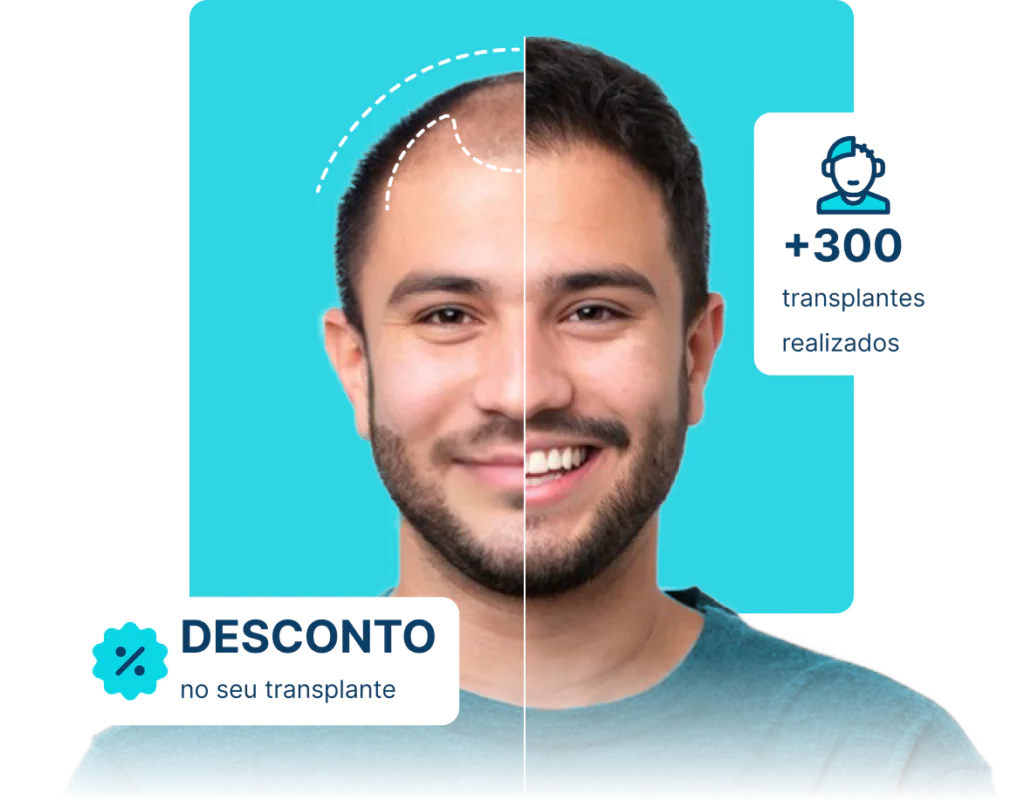 Transplante capilar com valores acessíveis 6 Group 983 1