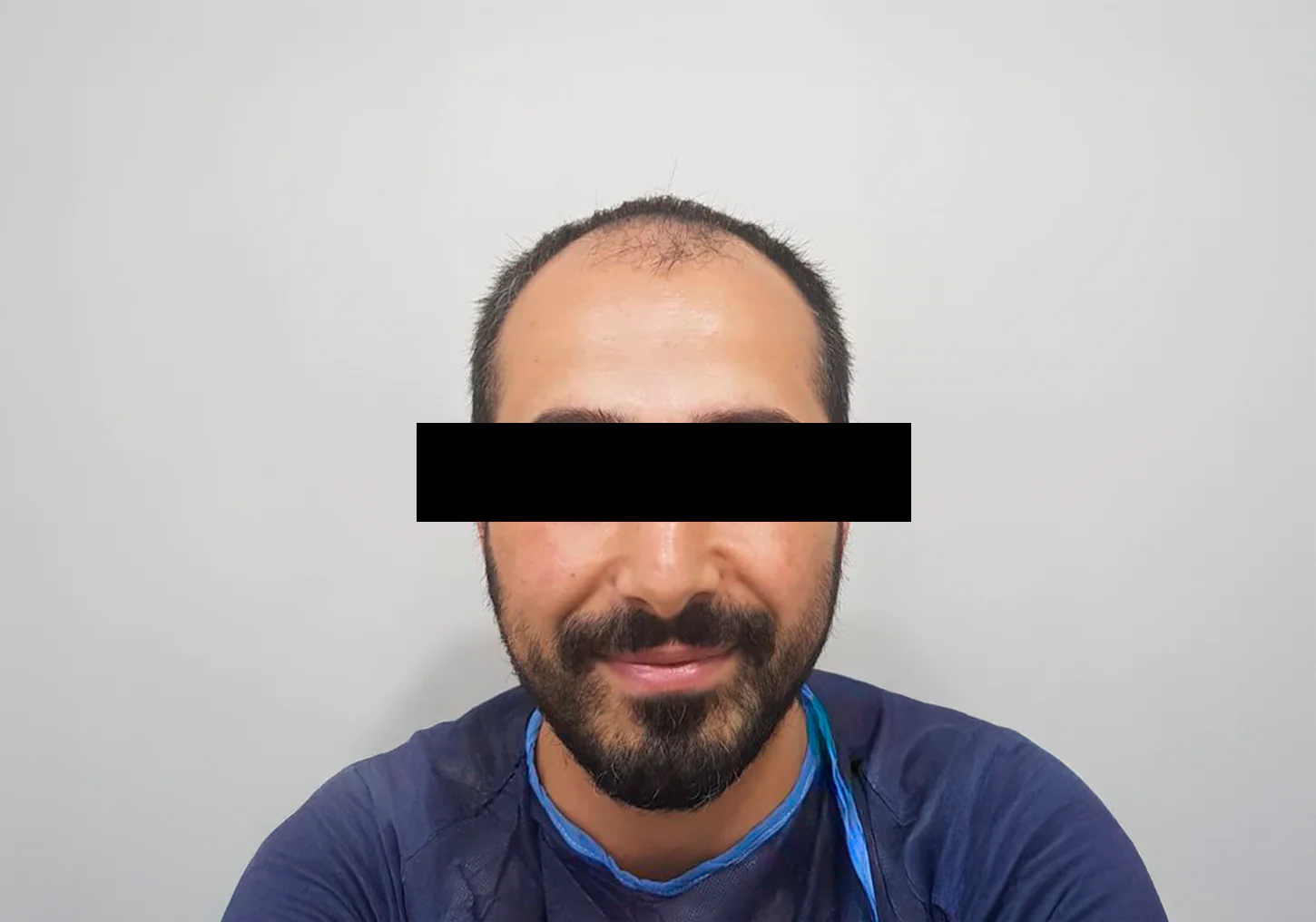 antes-transplante antes-transplante