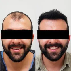 Transplante capilar com valores acessíveis 14 antes-e-depoiss-transplante-capilar-1