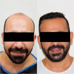 Transplante capilar com valores acessíveis 11 antes-e-depoiss-transplante-capilar-2