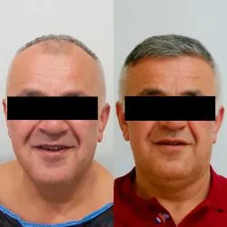 Transplante capilar com valores acessíveis 12 antes-e-depoiss-transplante-capilar-4